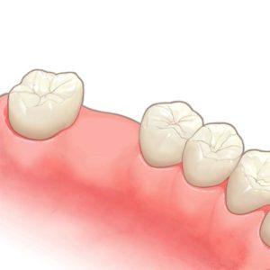 尼崎市　歯医者　アキ歯科クリニック　補綴物　歯の詰め物　ブリッジ