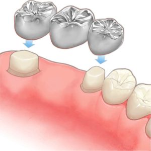 尼崎市　歯医者　アキ歯科クリニック　補綴物　歯の詰め物　ブリッジ
