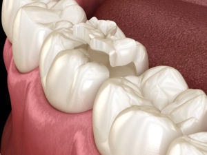 尼崎市　歯医者　アキ歯科クリニック　補綴物　歯の詰め物　セラミックインレー　ジルコニア