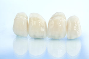 尼崎市　歯医者　アキ歯科クリニック　補綴物　歯の詰め物　セラミッククラウン