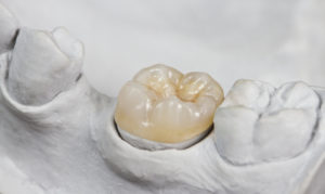 尼崎市　歯医者　アキ歯科クリニック　補綴物　歯の詰め物　セラミッククラウン