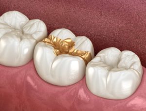 尼崎市　歯医者　アキ歯科クリニック 詰め物、被せ物　ゴールド