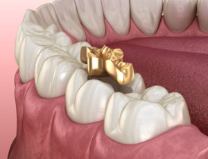 尼崎市　歯医者　アキ歯科クリニック　補綴物　歯の詰め物　ゴールドインレー