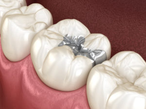 尼崎市　歯医者　アキ歯科クリニック　補綴物　歯の詰め物　メタルインレー