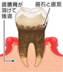 尼崎市　歯医者　アキ歯科クリニック 歯周病の進行