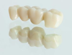 尼崎市　歯医者　アキ歯科クリニック 詰め物、被せ物　ジルコニア