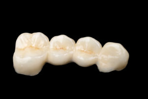 尼崎市　歯医者　アキ歯科クリニック　補綴物　歯の詰め物　ジルコニアブリッジ