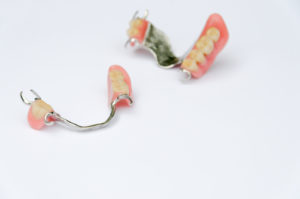 尼崎市　歯医者　アキ歯科クリニック　補綴物　歯の詰め物　部分床義歯