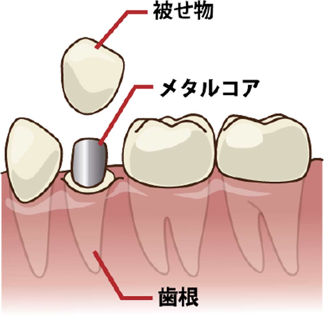 尼崎市　歯医者　アキ歯科クリニック　歯が黒くなった？？