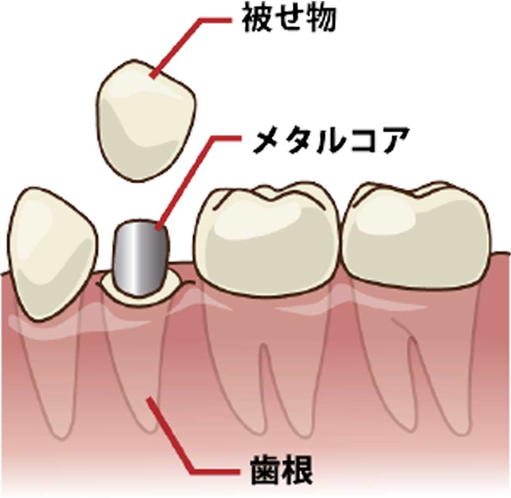 尼崎市　歯医者　アキ歯科クリニック　歯が黒くなった？？