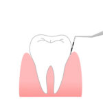 尼崎市　歯医者　アキ歯科クリニック 歯肉の深さを測る